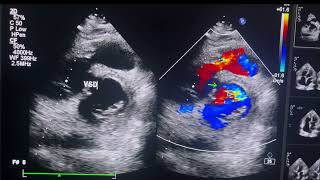 LARGE CONOVENTRICULAR VSD SHUNTING BIDIRECTIONALLYSEVERE INFUNDIBULAR OBSTRUCTIONheartcondition [upl. by Stauffer]