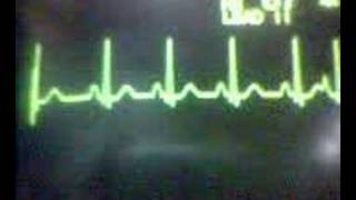 ECG Video Ectopics  Atrial [upl. by Brottman243]