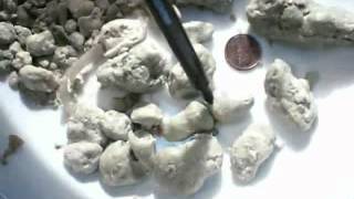 GALL amp Liver Stones the DARK Black Stones is DEAD PARASITES quot READ DESCRIPTIONquot [upl. by Gayleen]