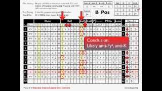 Antibody ID Basic Cases Part 2 [upl. by Manfred]