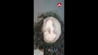 Folliculitis Decalvans Surgical Excision Before and After  Dr Sanusi Umar [upl. by Liam150]