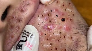 Big Cystic Acne Blackheads Extraction Blackheads amp Milia Whiteheads Removal Pimple Popping  5336 [upl. by Nywde187]