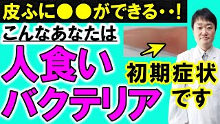 【放置禁止】「人食いバクテリア」劇症型溶血性レンサ球菌感染症の5つの初期症状、治療や予防を医師が解説 [upl. by Jeffcott]