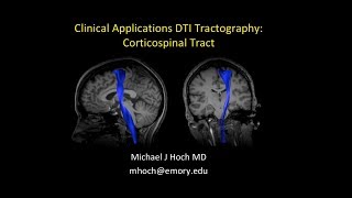 MRI Diffusion Tensor Imaging DTI interpretation  locating the corticospinal tract CST [upl. by Assele]