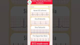 ECG Made Easy ecg mbbs neet ecginterpretation nursing youtubeshorts viral trending shorts [upl. by Airtal]