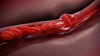 Sickle Cell Disease Animation [upl. by Babette]