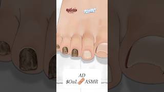 ASMR Ingrown Toenail Removal Treatment AnimationStrong Satisfaction mengstopmotion [upl. by Anilec]