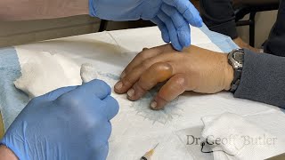 Drainage of blisters secondary to frostbite [upl. by Shelba]