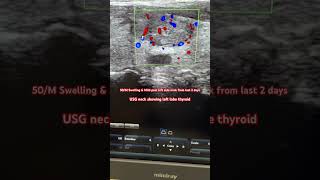 Thyroid nodule Thyroid Mass TIRAD4 video shorts reels neck pain thyroid ultraradiology [upl. by Ahsiei]