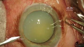 Phacoemulsification in an eye with Phacolytic Glaucoma amp loose Zonules  CTR  Dr Deepak Megur [upl. by Lyndel209]