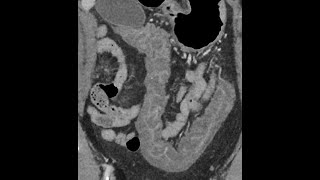 Pancolitis  acute onset  CT findings [upl. by Geiger835]