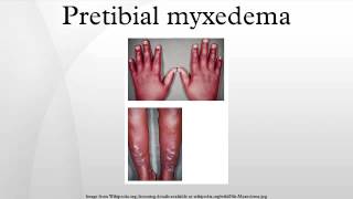 Pretibial myxedema [upl. by Netsud]