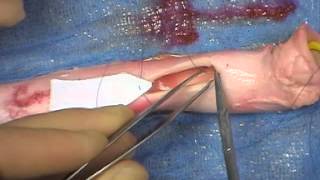 Basic Surgical Technique Vein patch [upl. by Whyte135]