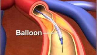 Percutaneous coronary Intervention stenting [upl. by Hoopes745]