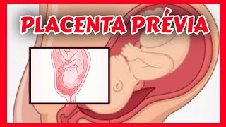 Comprendre le placenta previa [upl. by Anelak]