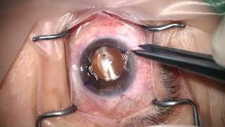 multifocal IOL fixation 1 [upl. by Akinirt]