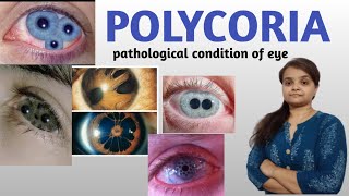 POLYCORIA Pathological condition of human eye [upl. by Klinges]