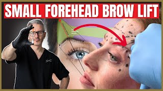 How To Perform a Botox Brow lift on a small forehead [upl. by Salamanca199]