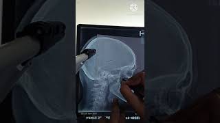 Cephalometrics tracing demonstration I DrHassan Rasheed [upl. by Erolyat]