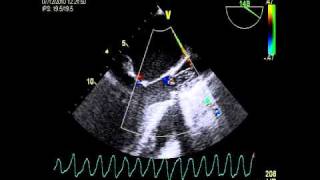 Cardiac arrest VENTRICULAR FIBRILLATION DURING TOE [upl. by Enella]