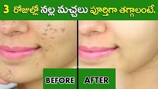 How To Remove Black Spots On Face In Telugu  Latest 2018  Beauty Tips In Telugu  Star Telugu YVC [upl. by Tybalt]