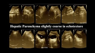 Coarse hepatic parenchymal  Ultrasonography report  liver disease  Amader Hospital  P1 [upl. by Akselaw817]