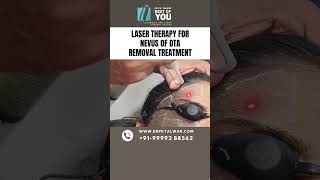 Laser Therapy for Nevus of OTA Removal Treatment  Nevus of OTA Treatment in Delhi  Dr PK Talwar [upl. by Baker]