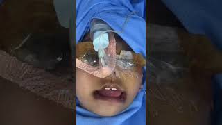 Rare Bilateral Tessier 7 Type Facial Cleft a correction  Macrostomia with multiple ear tags [upl. by Nitaf]