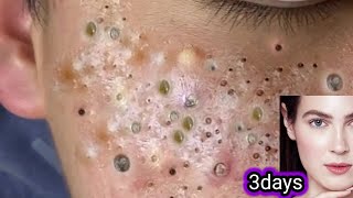 blackhead and whiteheads removal👌facial how to reduce acnepimpleblackheadsget fairclear skin [upl. by Elik]