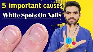 Leukonychia causes  5 important causes of white spots on nails [upl. by Park464]