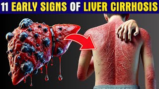 LIVER is DYING 11 Early Warning Signs of Liver Cirrhosis You Cant Ignore  Healthy Care [upl. by Nafis]