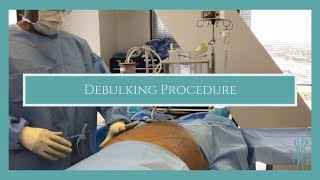 Debulking Procedure [upl. by Hogue916]