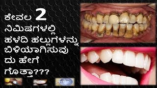 How To White Teeth In Kannada  Teeth Cleaning At Home In Kannada  Teeth Whitening in Kannada [upl. by Doubler]