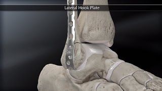 Lateral Hook Plate [upl. by Brick]