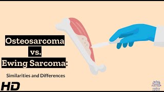 Osteosarcoma vs Ewing Sarcoma A Comparative Analysis [upl. by Aiuqat]