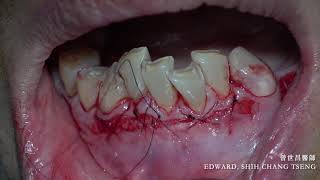 Apicically repositioned flap  APF with labial strip free gingival graftFGG [upl. by Akilak]