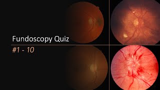 Fundoscopy Quiz [upl. by Hess]