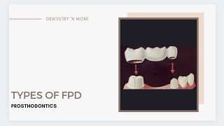 TYPES OF FPD [upl. by Gardy]