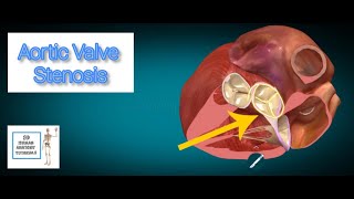 Aortic Valve Stenosis I Human Anatomy Tutorial [upl. by Marylin]