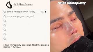 Asian Rhinoplasty Before and After  DrHarun Acıpayam [upl. by Rehpoitsirhc740]