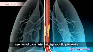 Esophageal Stent [upl. by Joya647]