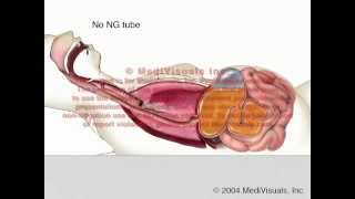 NG Tube vs Aspiration  Fluid Regurgitation [upl. by Lemieux]