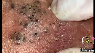 Dr Pop  Deep Blackheads in old Skin removing amp treatment 2020 Part 6 [upl. by Politi]