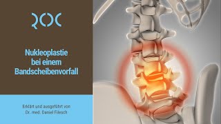 Nukleoplastie bei einem Bandscheibenvorfall  ROC Aschheim [upl. by Ahsita576]