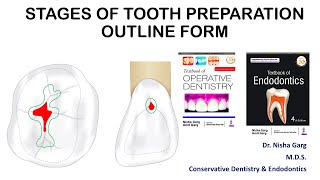 STAGES OF TOOTH PREPARATION  OUTLINE FORM  MADE EASY [upl. by Calvina]