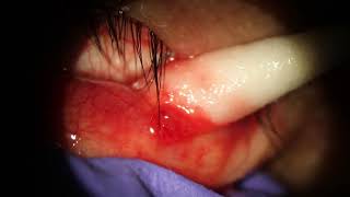 Chalazion Popped on inner eyelid w needle [upl. by Hsatan]