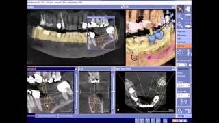 Sichere Implantate dank Cerec [upl. by Frederik891]