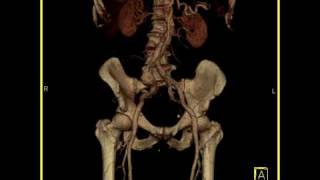 Vascular Right common iliac artery aneurysm Volume rendering [upl. by Myke]