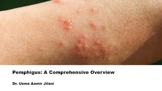 Understanding Pemphigus Causes Symptoms and Treatment of This Rare Autoimmune Skin Disorder [upl. by Jarad]