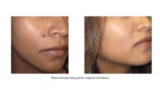 Before amp After Mole Removal Photos 2 by Dev Wali MD Board Certified Plastic Surgeon [upl. by Punke]